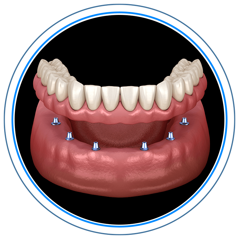 implant supported denture1